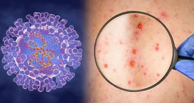 Phát hiện khác biệt di truyền trong virus đậu mùa khỉ năm 2022